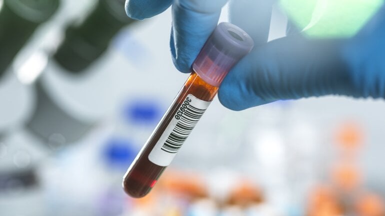 Erhöhter Calciumspiegel als Ursache einer Pankreatitis