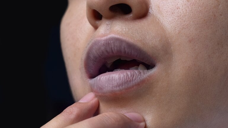 Symptom bei Panzerherz: Blaue Lippen 