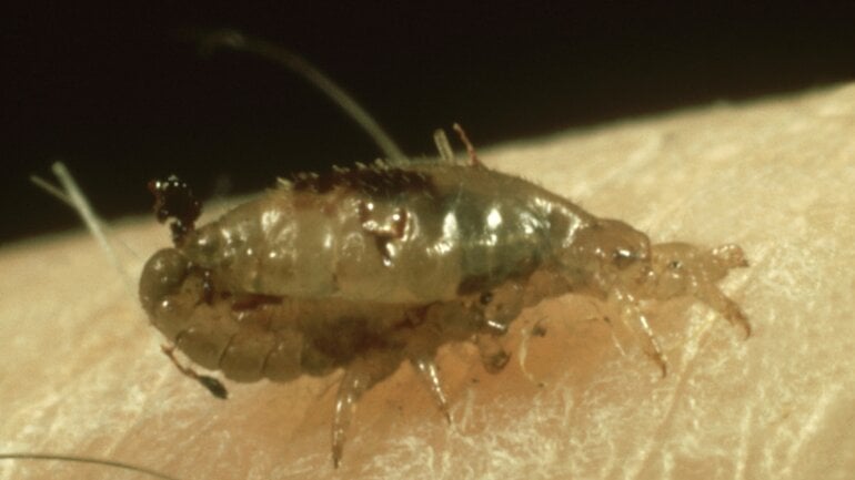 Parasiten im Haar: Kopfläuse betreffen oft Kinder