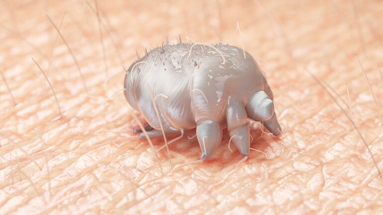Parasiten unter der Haut: Krätzmilben