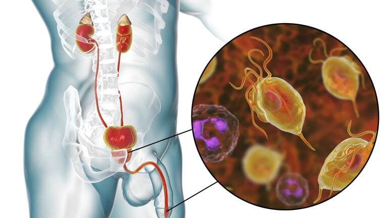 Bild von Trichomonas vaginalis: Parasit befällt die Harnröhre