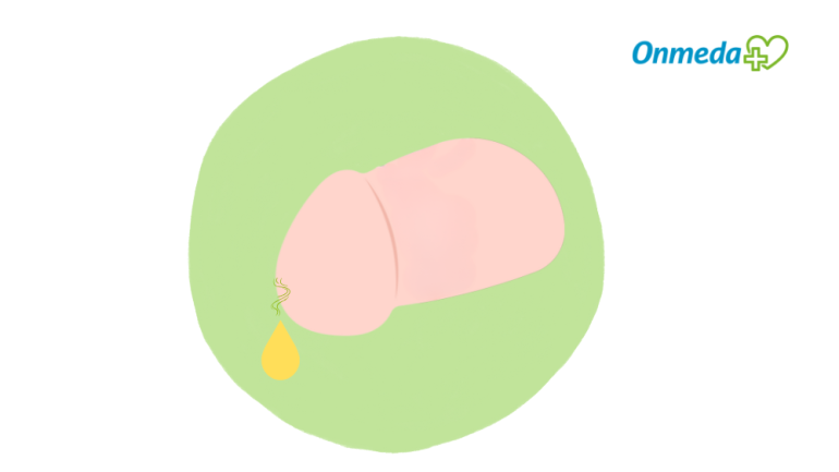 Eitriger und übelriechender Ausfluss aus dem Penis