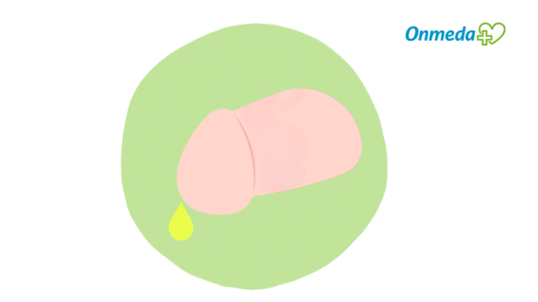 Ursache von gelb-grünlichem Ausfluss aus dem Penis