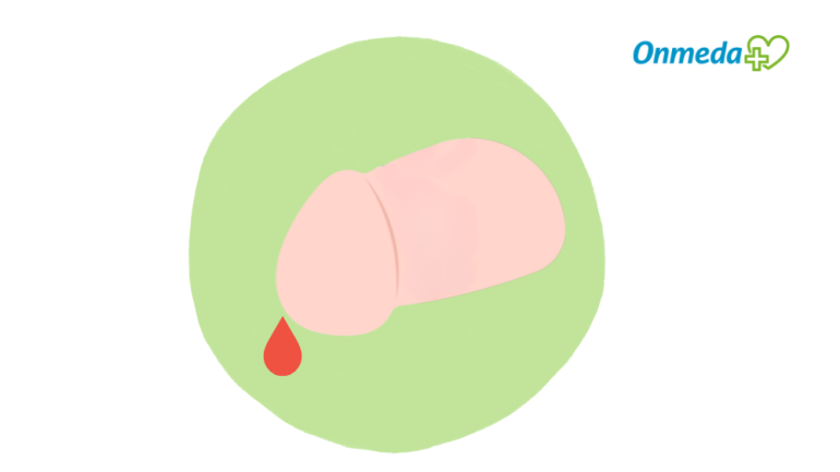 Bräunlicher oder blutiger Ausfluss aus dem Penis