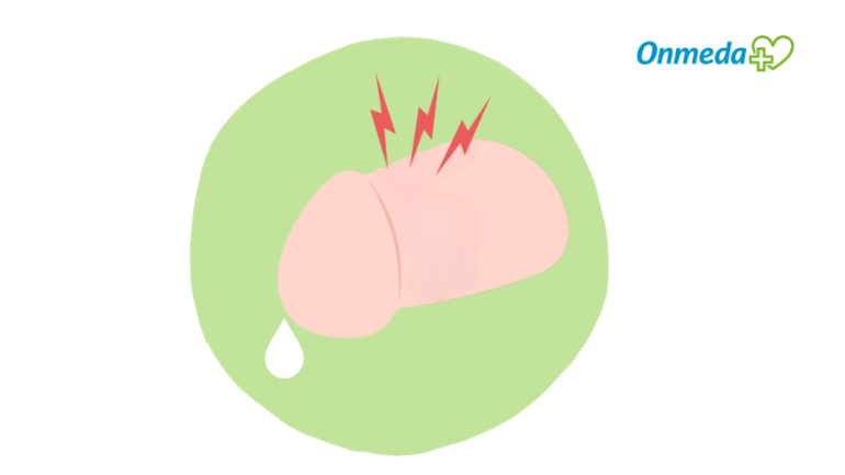 Weißlicher Ausfluss aus dem Penis mit weiteren Beschwerden