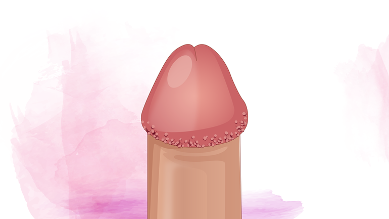 Was sind Hornzipfel am Penis?