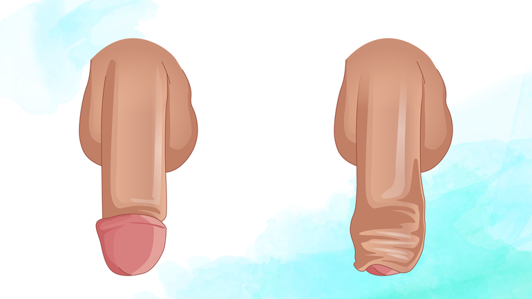 Penis: Mit Vorhaut oder ohne