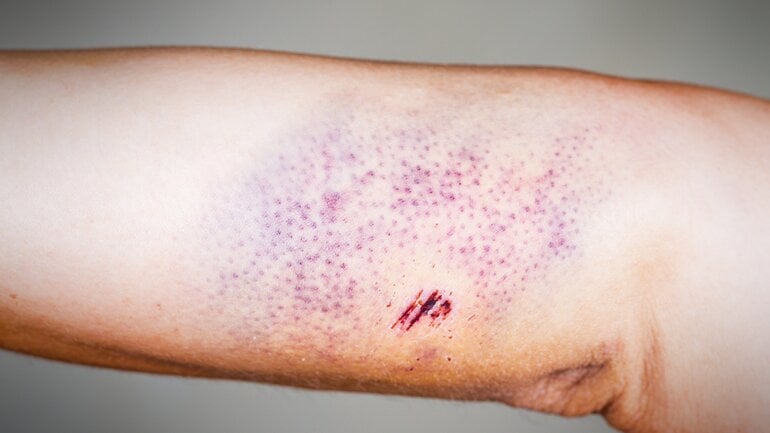 Petechien: Häufige Ursache ist Druck und Reibung auf der Haut
