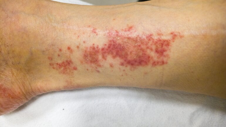 Gefäßentzündungen können zu Petechien führen