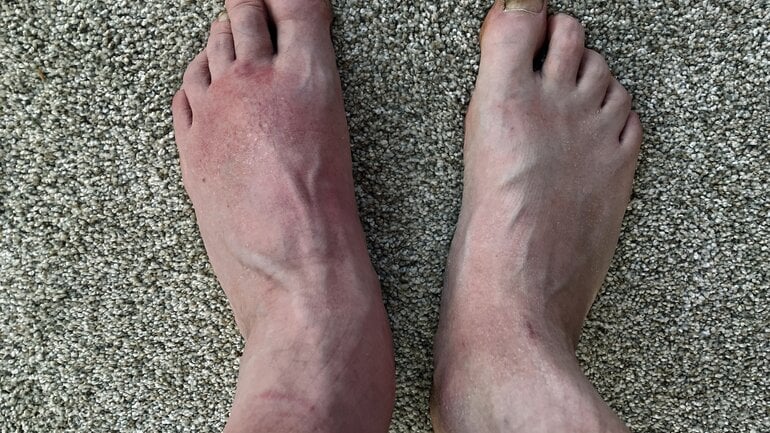 Phlegmone am Fuß: Schwellung ist häufiges Symptom 