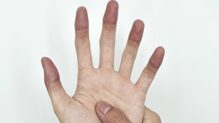 Sauerstoffmangel: Symptome der Haut