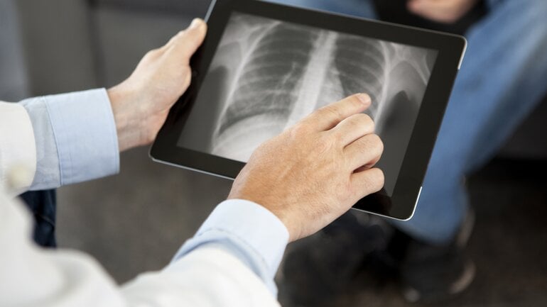 Metastasen in der Lunge durch Schilddrüsenkrebs