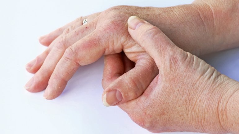 Psoriasis-Arthritis bei Schuppenflechte möglich