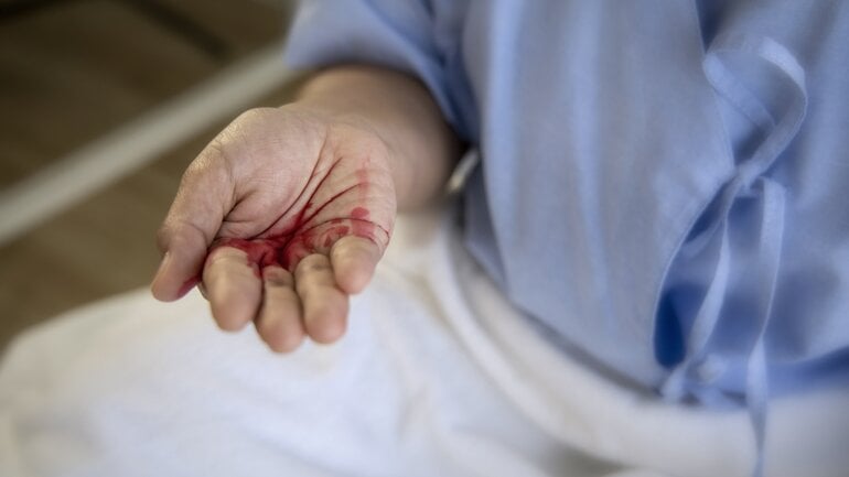 Häufiges Symptom bei Plattenepithelkarzinom der Lunge: Bluthusten