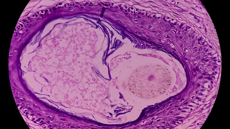 Reife Teratome enthalten Gewebe wie Haut, Zähne und Haare