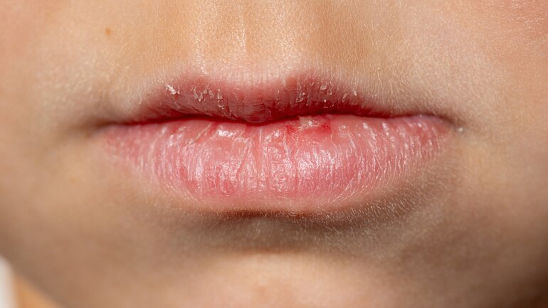 Ursachen für trockene Lippen: Wind und Heizungsluft