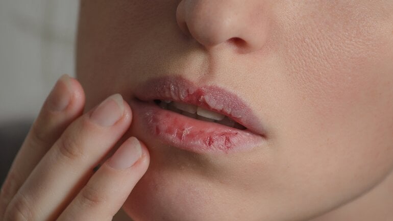 Ursache für trockene Lippen: Flüssigkeitsmangel