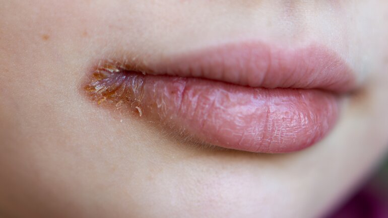 Mangel als Ursache für trockene, brennende Lippen