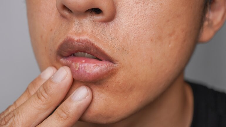 Trockene, brennende Lippen durch Lippenlecken