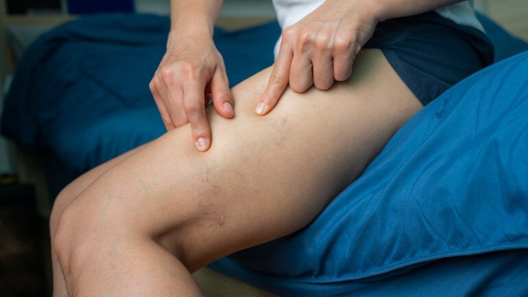 Venenschwäche kann zu Besenreisern führen