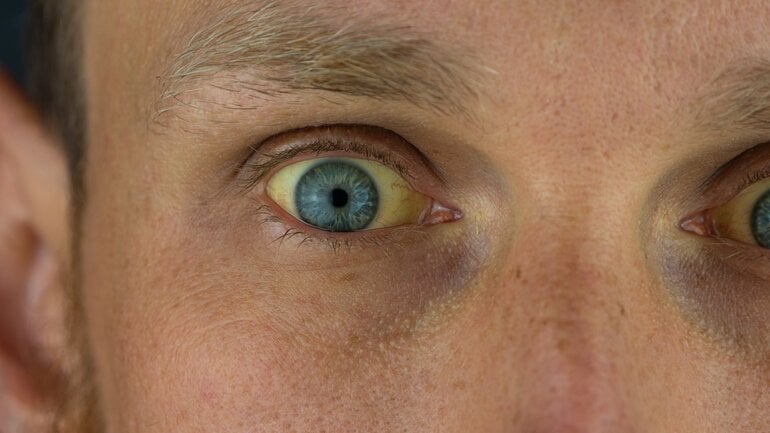 Gelbsucht kann für Probleme der Bauchspeicheldrüse sprechen