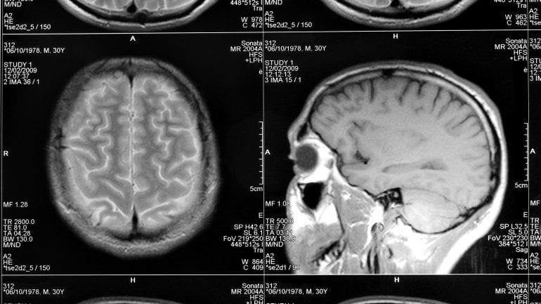Das Bild zeigt eine MRT-Aufnahme eines Kopfes.