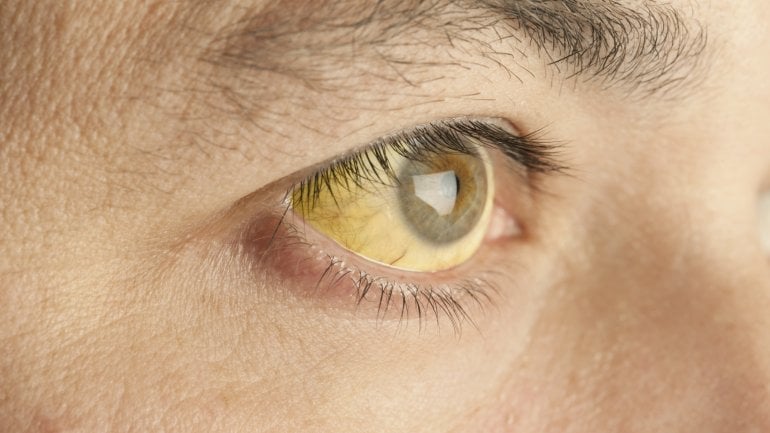 Das Bild zeigt das Auge eines Gelbsucht-Betroffenen. 