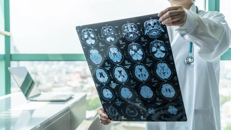 Ein Arzt hält ein MRT-Bild mit Aufnahmen eines Gehirns hoch