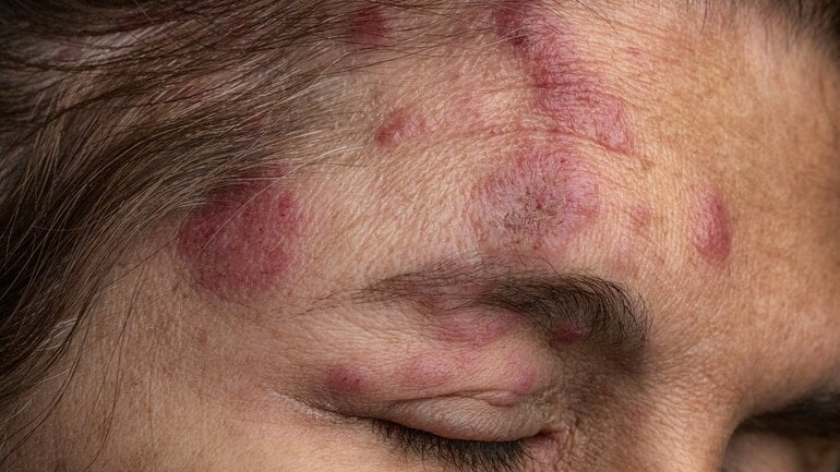 Fehler bei Gürtelrose: Symptome im Gesicht nicht ernst nehmen