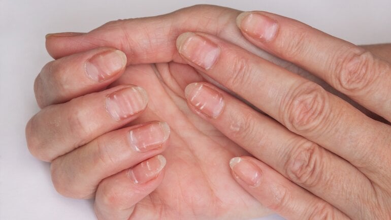 Mangel an Zink kann für Haarausfall sorgen