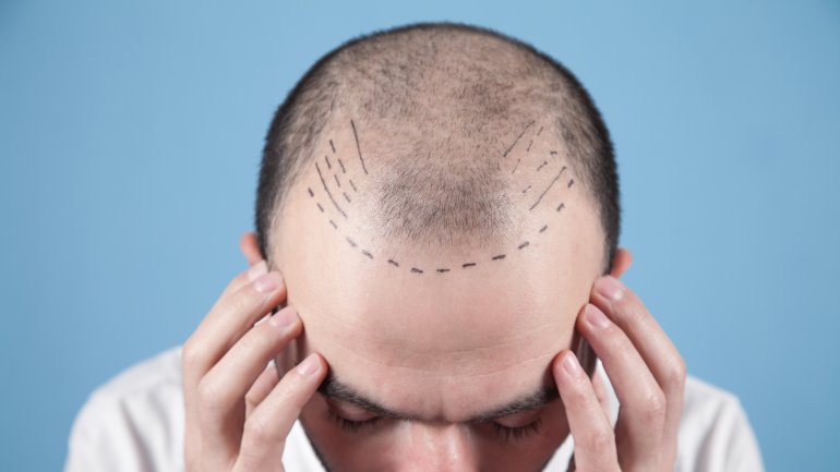 Man sieht den Kopf eines Mannes, der für eine Haartransplantation vorbereitet wird.