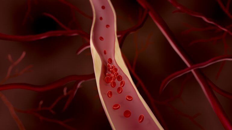 Arteriosklerose: Die Grundlage vieler Herzkrankheiten