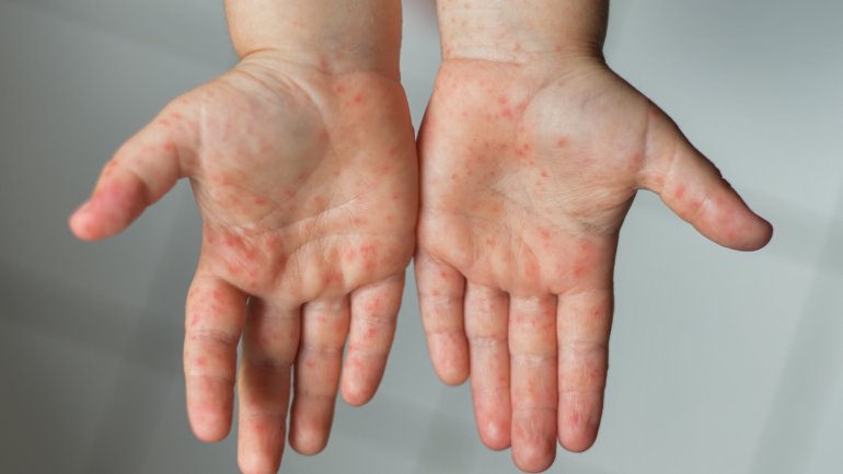 Hand-Fuß-Mund-Krankheit: Kind zeigt Hände mit Ausschlag.