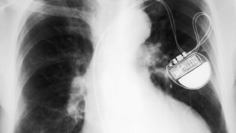 Das Bild zeigt ein Röntgenbild eines Herzschrittmachers.