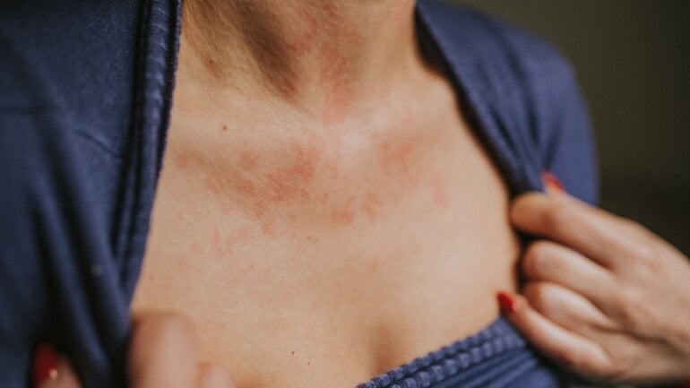 Histaminintoleranz: Hautrötung ist ein Symptom