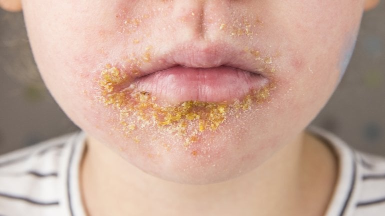 Borkenflechte: Bild von einem Kind mit Impetigo contagiosa um den Mund.