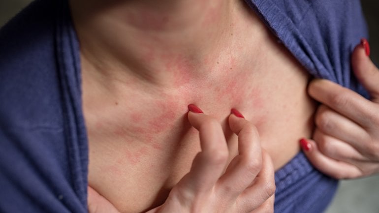 Kontaktallergie: Bild einer Frau mit Kontaktdermatitis, die sich im Dekolleté kratzt.