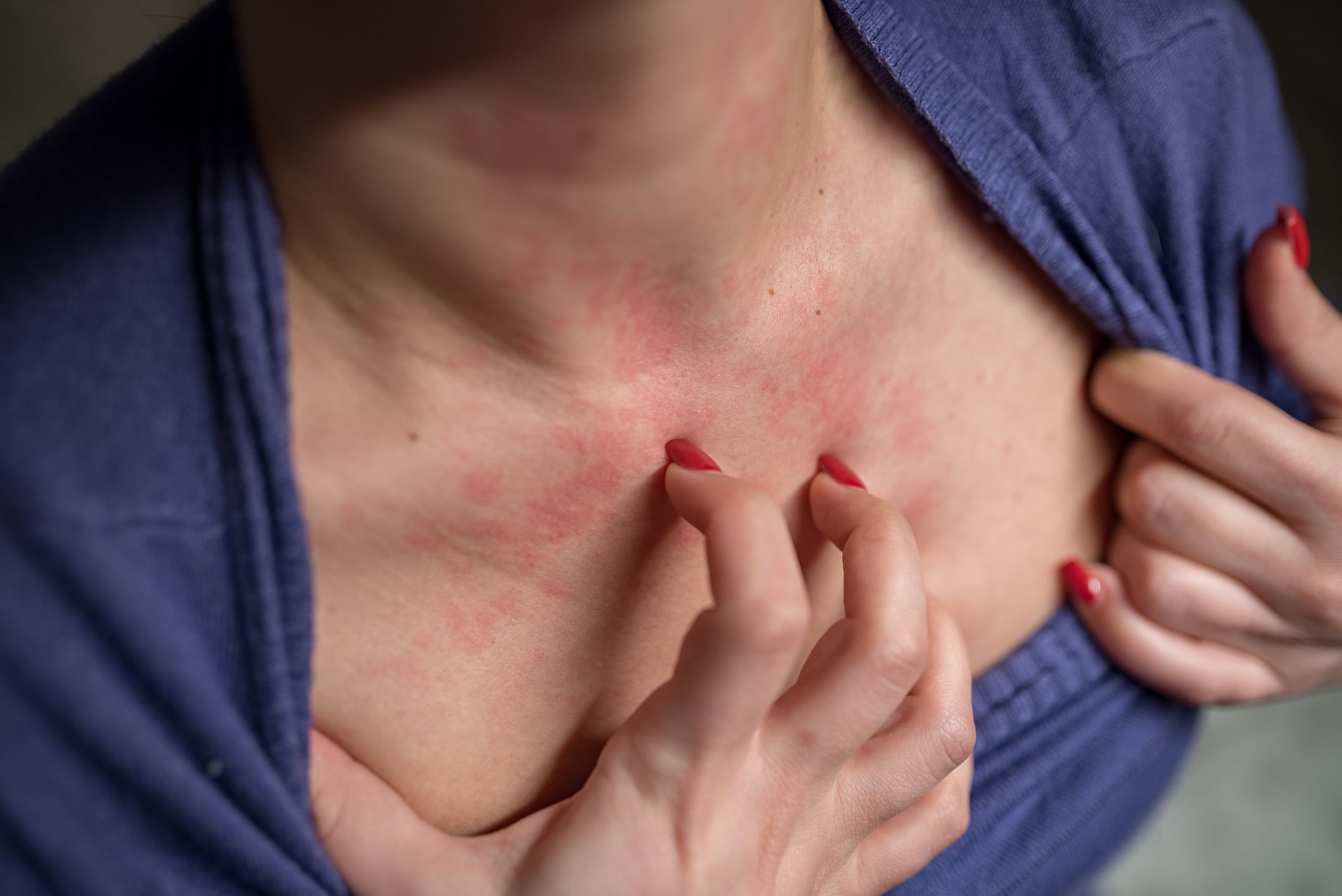 Kontaktallergie: Symptome & Behandlung bei Kontaktdermatitis