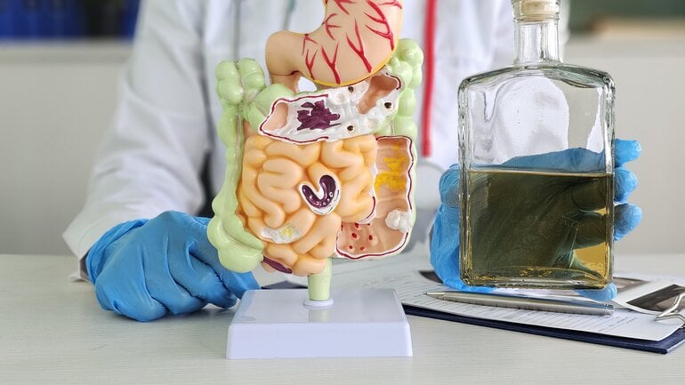 Darmkrebs kann durch Alkohol und Rauchen gefördert werden