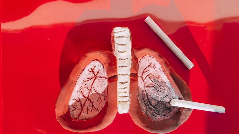 Lungenkrebs: Rauchen ist der wichtigste Risikofaktor