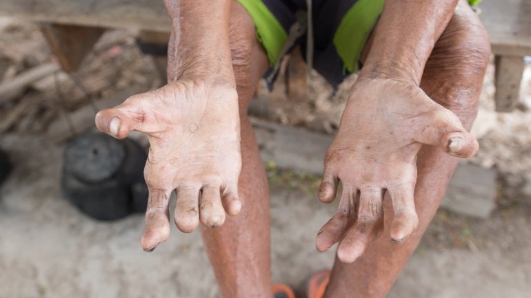 Person zeigt Hände, die von Lepra deformiert sind