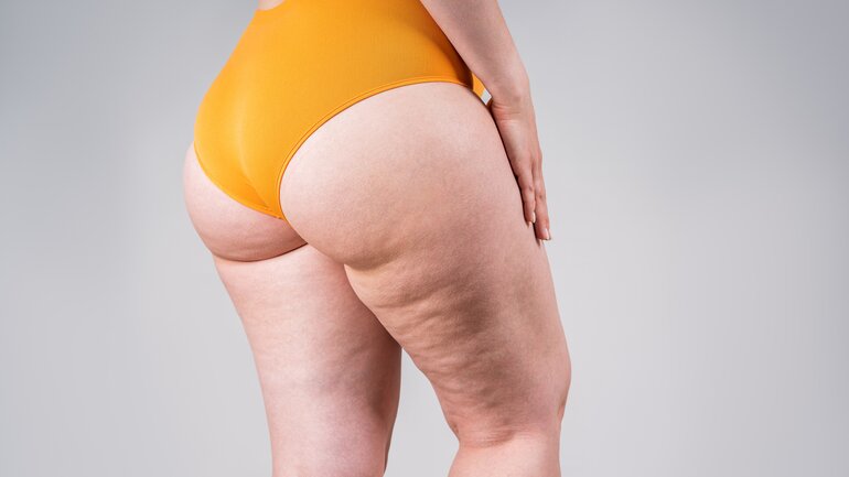 Vegleich in Bildern: Cellulite oder Lipödem? 