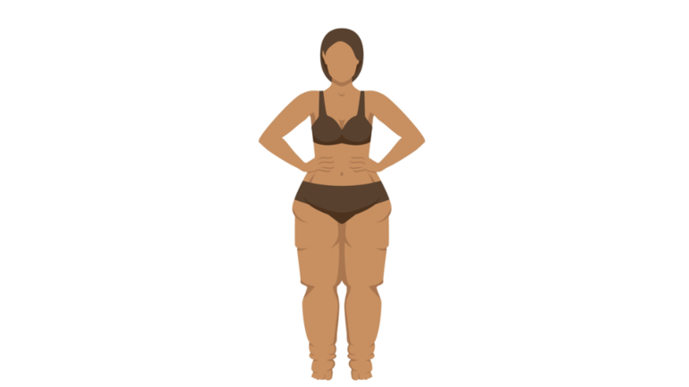 Lipödem-Bilder der Beine im Stadium 3