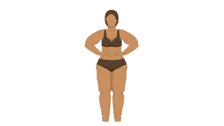 Frauen mit Lipödem an den Armen – Bilder vom Typ 4