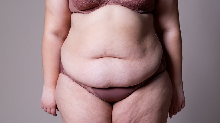 In Bildern: Lipödem am Bauch ist keine eigenständige Variante