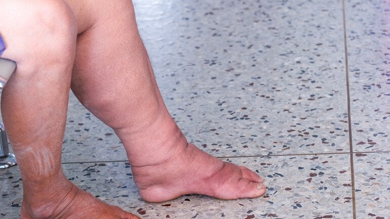 Lipödeme haben fortschreitenden Verlauf