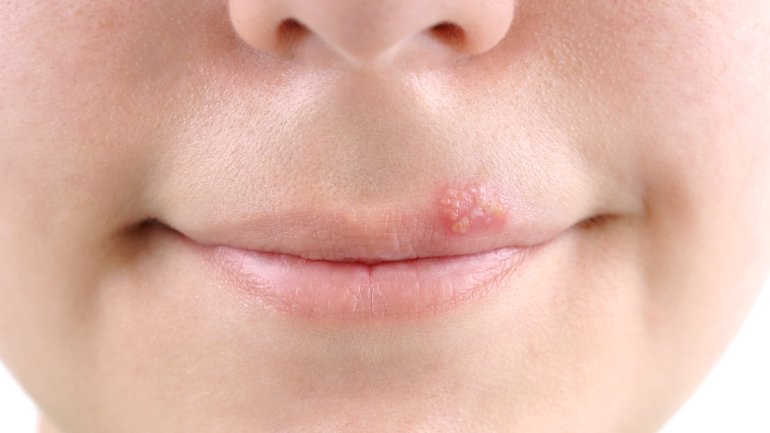 Bild: Wie sieht Herpes an der Lippe aus?