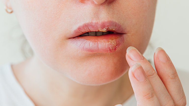 Lippenherpes: Bild des Heilungsverlaufs