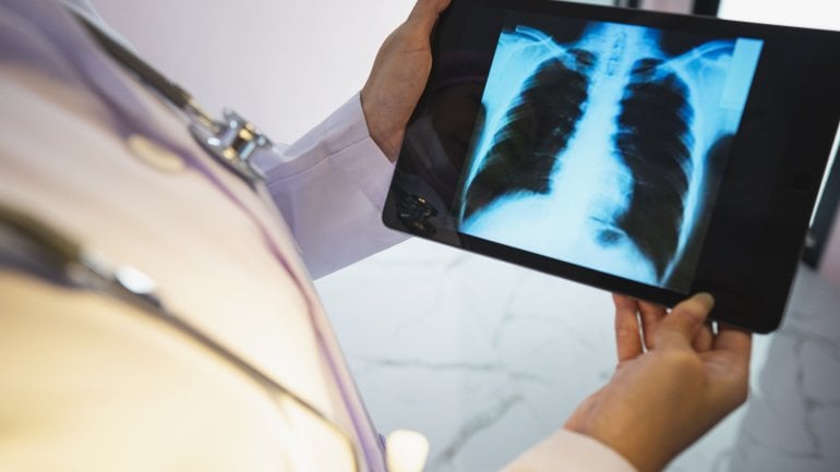 Arzt hält Röntgenbild von Lungenemphysem in der Hand.