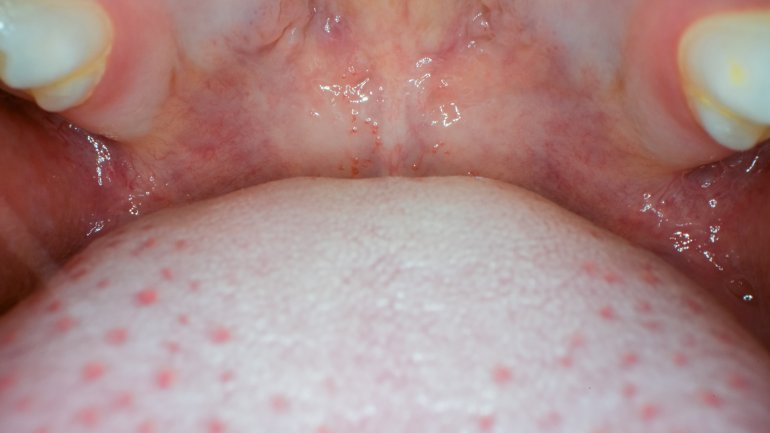 Koplik-Flecken sind ein häufiges Symptom bei Masern